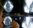 Study Finds Worse Cancer Survival During Pandemic