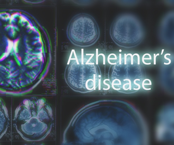 images of brain with Alzheimer's disease