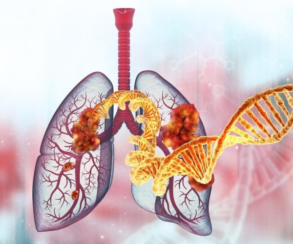 illustration of cancer in the lungs