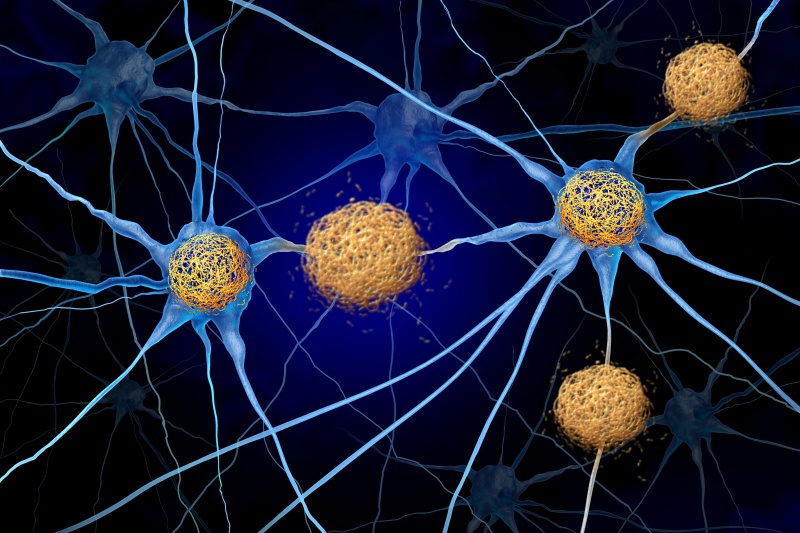 Why Cancer Might Protect Against Alzheimer's