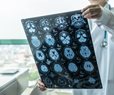 Pre-Immunotherapy Laser Boosts Brain Cancer Survival