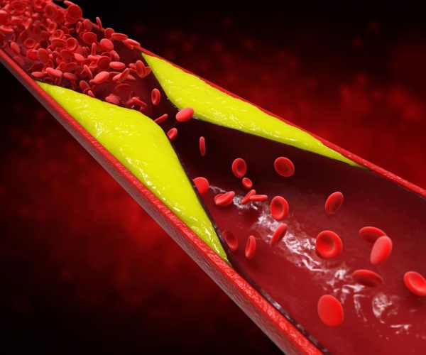 illustration of buildup of cholesterol in an artery