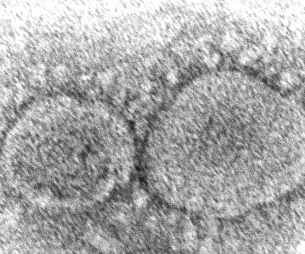 microscopic view of SARS-CoV-2 virus particles that cause COVID