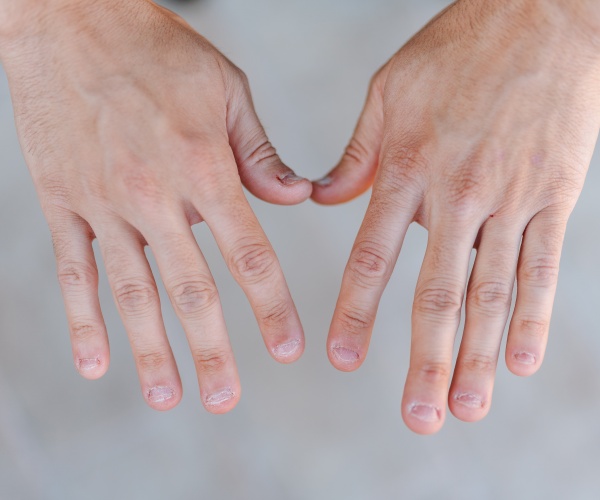 two hands showing damaged and bitten fingernails