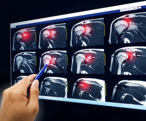 x-ray of shoulder/rotator cuff tear