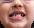 FDA, RFK Jr. to Remove Kids' Fluoride Supplements