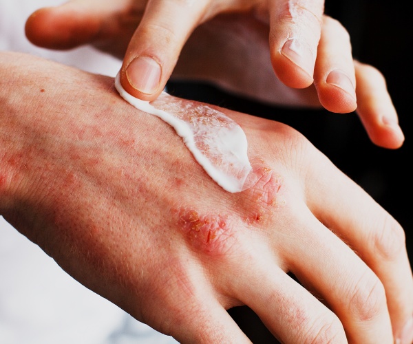 person putting lotion on psoriasis on hands