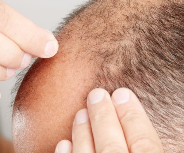 close up of the head of a man with thinning hair