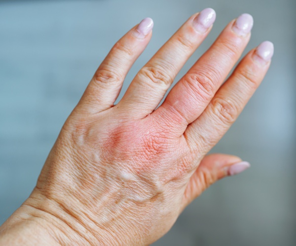 woman's hand with a swollen finger