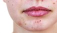 Study: Low-Cal Keto Diet Effective Against Acne