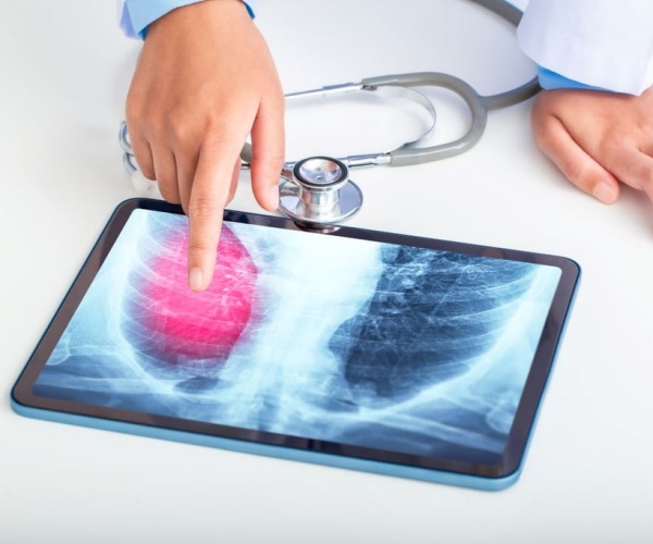 x-ray of lungs with lung cancer