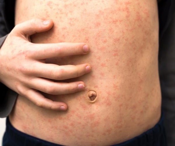 child's torso with measles 