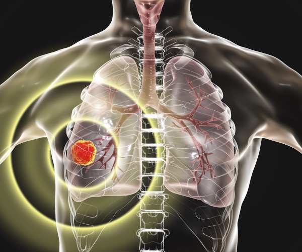 illustration of cancer in one lung