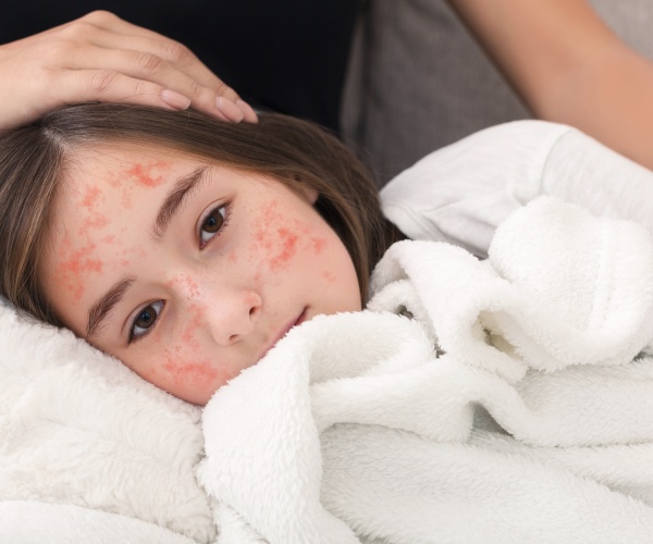 young girl with measles