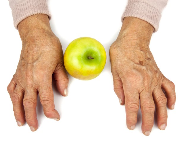 rheumatoid arthritis 