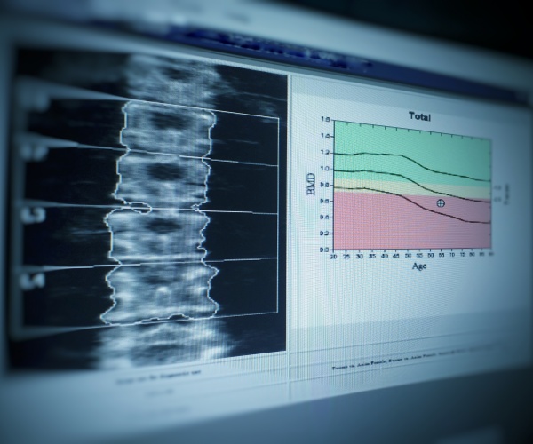 image of lumbar spine showing decrease in bone density