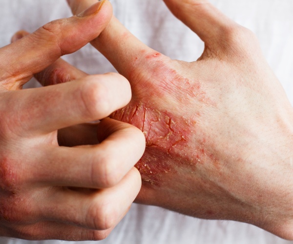 closeup of hands with eczema