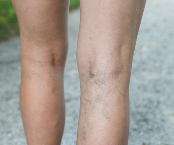woman's legs with varicose veins