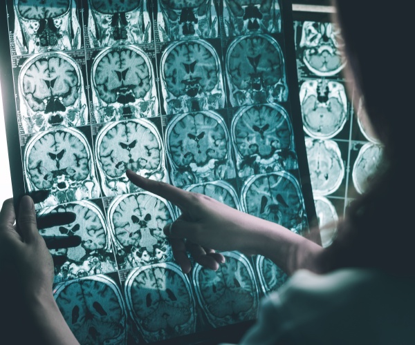 doctor looking at images of brain with Alzheimer's disease