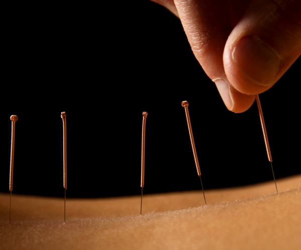 acupuncture needles on a person's back