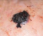 Less Melanoma-Fighting Immunotherapy More Effective