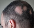 Microneedle Patches Promising for a Form of Hair Loss