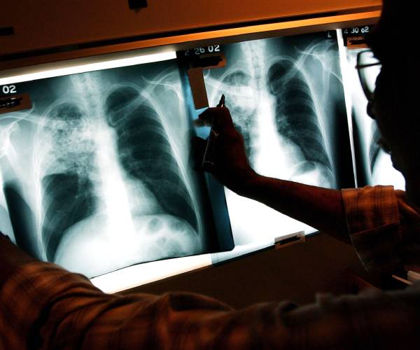 a doctor looking at chest x rays