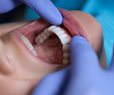 Study: Gum Disease Disrupts Brain Activity