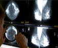 Some Breast Cancer Patients Can Avoid Surgery