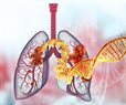 Why Cancer Spreads to the Lungs So Often