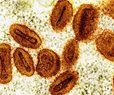 Health Officials: 1st US Case of New Form of Mpox