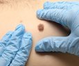 Skin Cancer Vaccine Reduces Recurrence, Death Risk