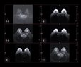 Mammograms May Reveal Hidden Heart Disease Risk