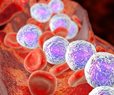 Genetic Test May Predict Leukemia Relapse Risk