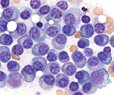 GSK Drug Cuts Death Risk in Multiple Myeloma