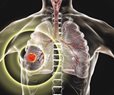 Chemo-Free Treatment Extends Lung Cancer Survival