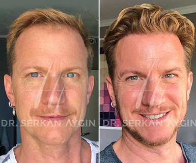 AscendAgency_HairTransplant_3-20_inarticleimage-385x320.jpg