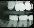 Study: PTSD Triples Odds for Teeth Grinding